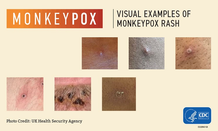 Monkeypox