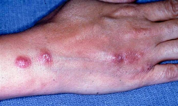 fungal infection candidiasis