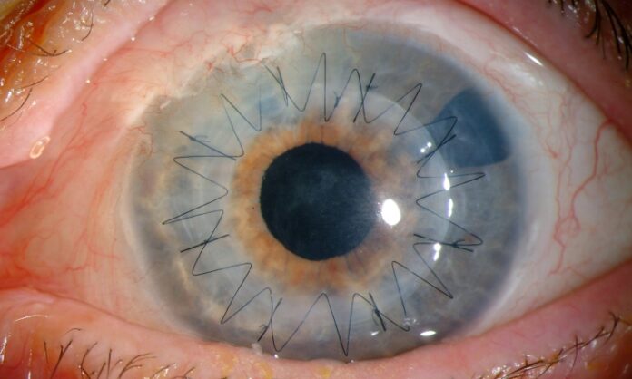 cornea transplant